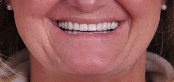 Conventional dentures: the same patient's smile after treatment with Dr. Charette.