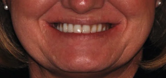 Conventional dentures: the patient's smile before treatment.