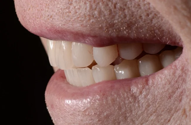 Upper denture, lower fixed hybrid: the same patient's smile after treatment with Dr. Charette.