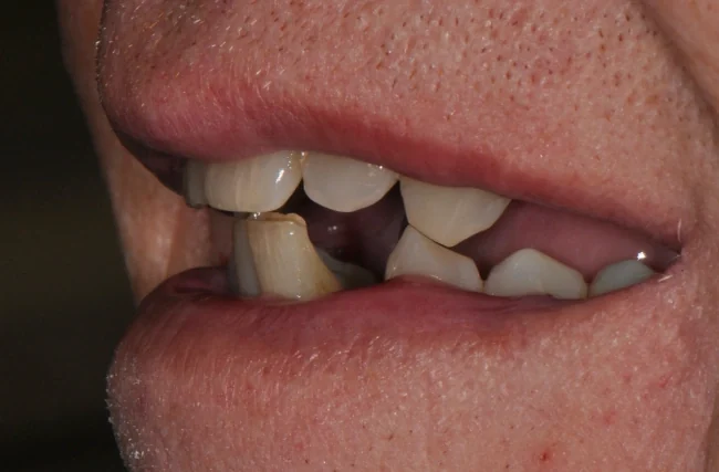 Upper denture, lower fixed hybrid: the patient's smile before treatment.
