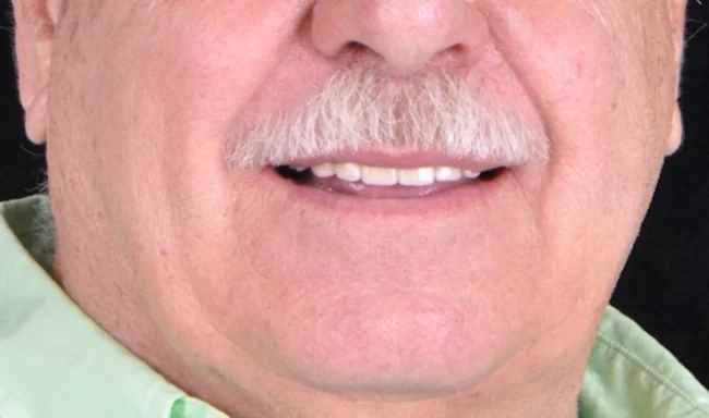 Implant-assisted partial: the same patient's smile after treatment with Dr. Charette.
